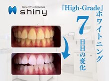 ホワイトニングサロン シャイニー 浜松細島店(shiny)/【超絶・美・白】ホワイトニング