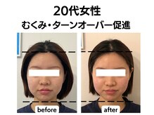 シン(SHINE)/美容鍼灸