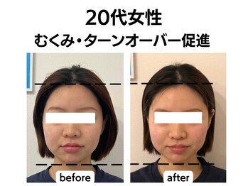 シン(SHINE)/美容鍼灸