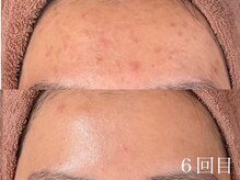 アワピール 天王寺店(AWA PEELL)/ハーブピーリング/ニキビケア