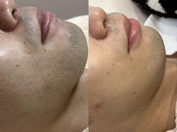 エミュ(emu formen)/肌も明るく美肌に変わります！