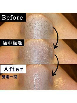 シャルムクリニカルサロン 池袋(Charme clinical salon)/毛穴洗浄＆ハイドラフェイシャル