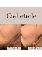 シエルエトワレ/【ニキビ特化】改善コース