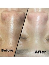 プチュリア(puCuria)/毛穴キレイピカピカに