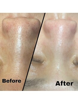 プチュリア(puCuria)/毛穴キレイピカピカに