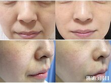 ナチュレアンドメディカ(Nature&Medica)/【たるみ改善】オンダリフトONDA