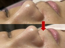 ブリリアン デイスパ 阪急西宮ガーデンズ店(BRILLIAN DAYSPA)/毛穴洗浄フェイシャル