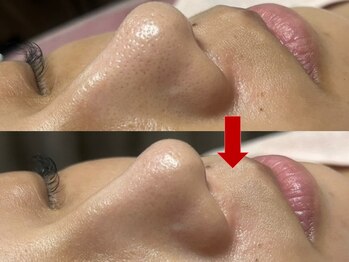 ブリリアン デイスパ 阪急西宮ガーデンズ店(BRILLIAN DAYSPA)/毛穴洗浄フェイシャル