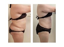 ユニクリア(Uni clear)/痩身　脂肪分解キャビテーション