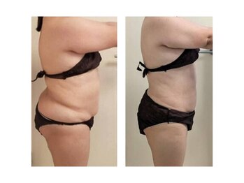 ユニクリア(Uni clear)/痩身 脂肪分解キャビテーション