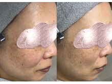 モガナ(mogana)/半年パスポート2ヶ月beforeafter