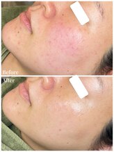 ちらちゅら/クリスティーナ＋毛穴洗浄