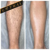 エピリア(Epilear)