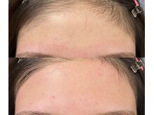 アイブロウサロン ミラ(Eyebrow Salon Mira)/額ワックスケア