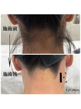 エピファニー(Epi phany Total Beauty Salon)/【WAX脱毛】うなじ
