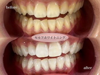 ビジュー(bjyou)/セルフホワイトニング