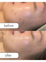 アール(R;)/跡のリカバリー