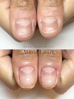 マリーロール 梅田店(Marie Laure)/深爪矯正/自爪育成/自爪風
