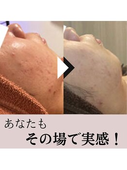 ベベ 大阪中央店(Be’be’)/トラブルが起きにくいお肌に。