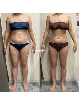 アネラ(anela)/オーダーメイド痩身