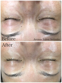 アンティミテ(Intimite)/【スキンケアコース】しわ改善