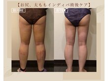 オキシー グレイス 黒崎店(OXY Grace)/太ももインディバ術後