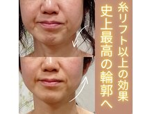 筋膜を引上げて首の長さも復活♪当店だけの技術☆詳細はブログで