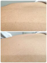 エステシェービングサロン フルール(Fleur)/背中のシェービング