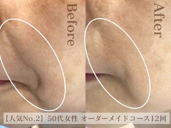 ディレイア ザ コスメ 有楽町マルイ店(direia the cosme)の写真/ほうれい線・たるみに集中アプローチ。ハリ艶引き上げ!!ドライヘッドスパ付で肩こりも◎[有楽町/毛穴/小顔]