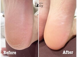 スパルーチェの角質ケア