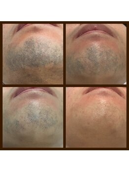 リアンジュ/ヒゲ脱毛の経過