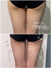 OBS新潟整骨院/脂肪冷却で美脚ゲット♪