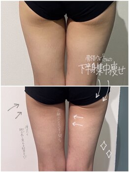 OBS新潟整骨院/脂肪冷却で美脚ゲット♪