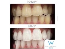 ホワイトニングショップ 山口店/山口ホワイトニング