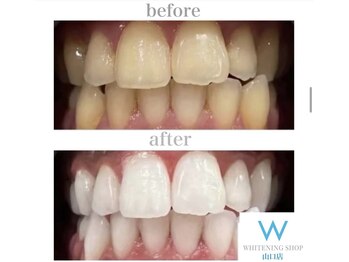 ホワイトニングショップ 山口店/山口ホワイトニング