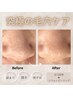 【2ヶ月以内にご来店の方限定】毛穴洗浄+剥離なしピーリング【2000円金券付】