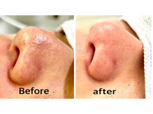 男性にも人気！リピート97%毛穴洗浄