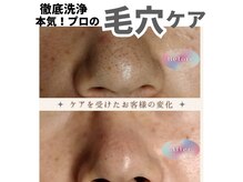 【メンズ脱毛】Beauty salon Lovina【ロビナ】長野駅前店の雰囲気（毛穴の黒ずみを除去してイチゴ鼻を卒業！）