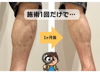 BRUSH/1回の施術でも効果があります