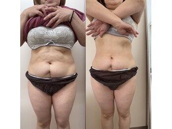 Kino Beauty Salon二子玉川店 ローマピンク/ホワイトラボ/脂肪冷却/シミ/メラニンケア/脂肪冷却