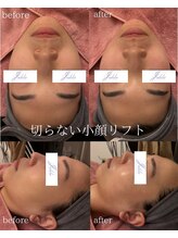 ユフラ(Juhla)/切らない小顔リフトサーマル