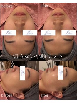 ユフラ(Juhla)/切らない小顔リフトサーマル