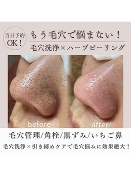 ウル 大阪野田店(Ulu)の写真/【看護師の肌管理】野田で毛穴改善ならココ!長年の黒ずみ/いちご鼻も初回から効果実感◎毛穴うる艶ケア
