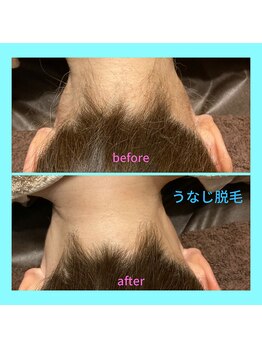 ラ シルク(La silk)/うなじ脱毛