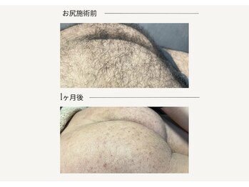 クレビア(CREVIA)/メンズおしり脱毛◆BeforeAfter