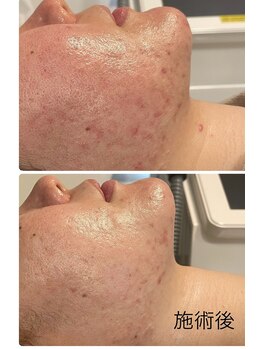 エヴァル 久留米店(ewalu)/ハーブピーリング