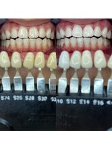 トウキョースワーズ 渋谷店(TOKYO SWRS)/#ホワイトニング #渋谷 #池袋