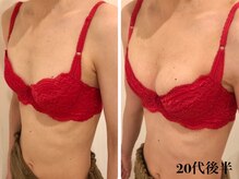 リール 新宿店(RIRE)/20代後半　 バストアップ症例