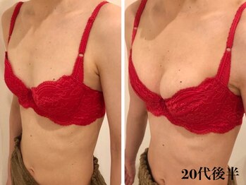 リール 新宿店(RIRE)/20代後半 バストアップ症例