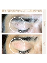 エスト(Est_.)/美容電気脱毛【眉毛】